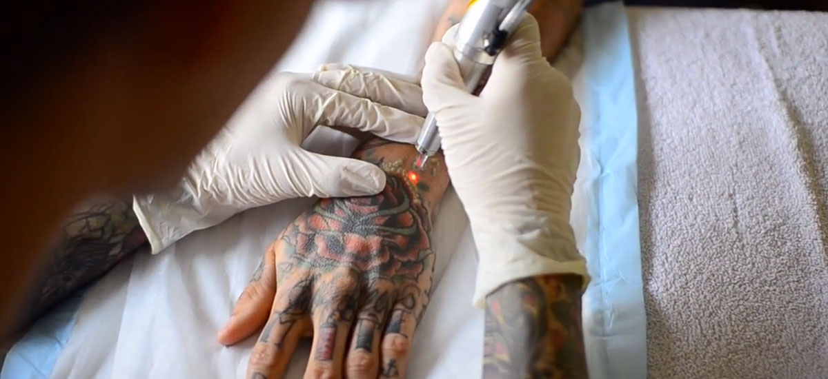 Cómo es posible eliminar un tatuaje completamente.